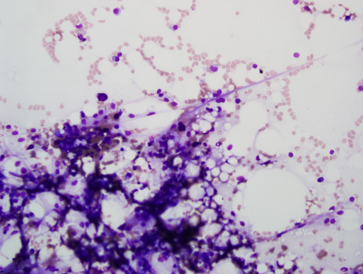 Bone marrow Aspirate March 2005